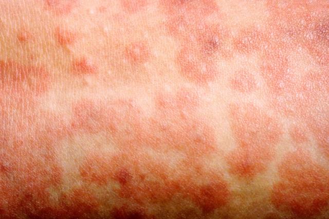 A 1017 measles rash D1BM7H.width 1125